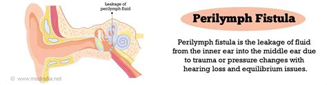 Perilymph Fistula