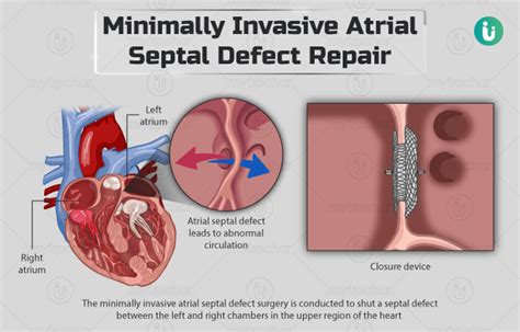 Minimally invasive atrial septal defect repair: Procedure, Purpose ...