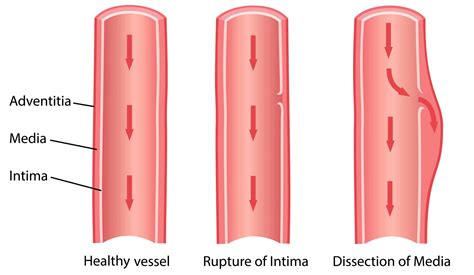 Dissecting Aneurysm