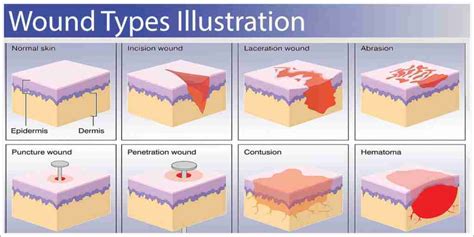 5.1 Lesson: Types of wounds - Siren Training