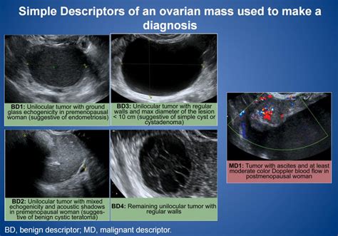 Ovarian Cyst On Ultrasound Image