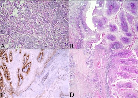 The histopathological findings of the tumor on mastectomy specimen. (A ...