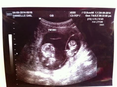 Danielle Dail: Ultrasound #2...Fraternal or Identical?