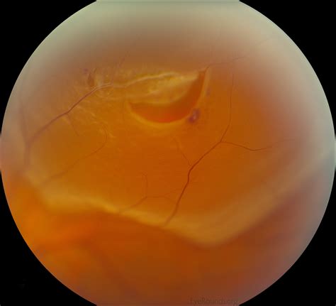 Vitreous Syneresis: An Impending Posterior Vitreous Detachment (PVD)