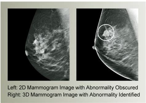 Get Screened: Why Women Should Have Annual Mammograms Starting at Age ...