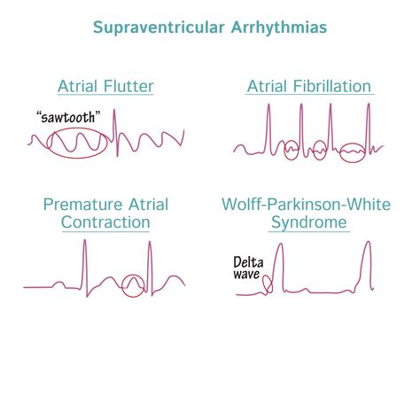 Pathology Glossary: Arrhythmias - Supraventricular | Draw It to Know It