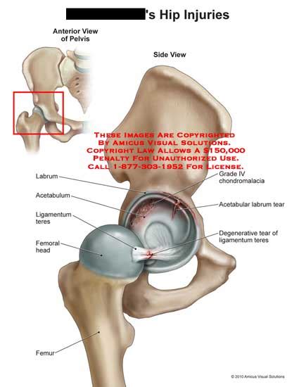 AMICUS Illustration of amicus,injury,hip,injuries,labrum,acetabulum ...