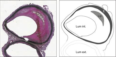 Histology of control sample: fibrous cap atheroma. Histology of control ...