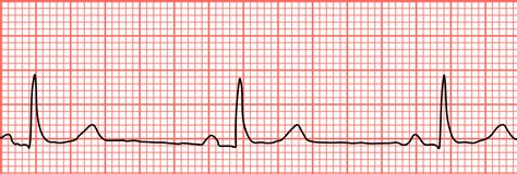 What You Should Know About Identifying and Treating Sinus Bradycardia