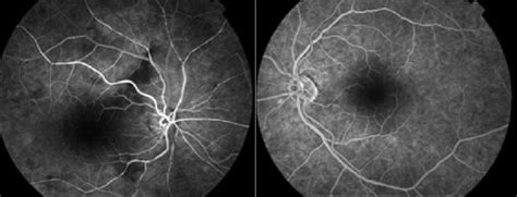 Fluorescein angiography indicated that the arm-to-retina circulation ...