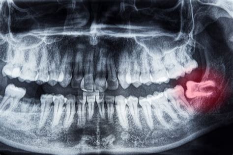 Worst Teeth In The World