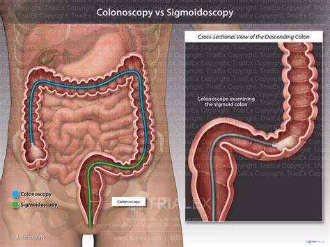 Colonoscopy vs Sigmoidoscopy - TrialQuest Inc.