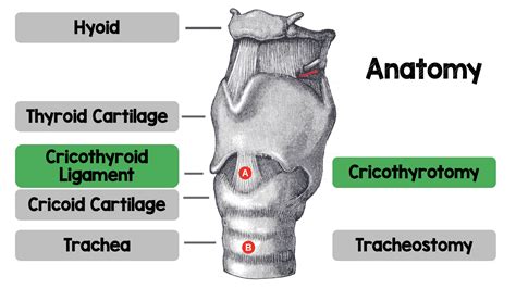 Bougie-Assisted Cricothyrotomy Anatomy - REBEL EM - Emergency Medicine Blog