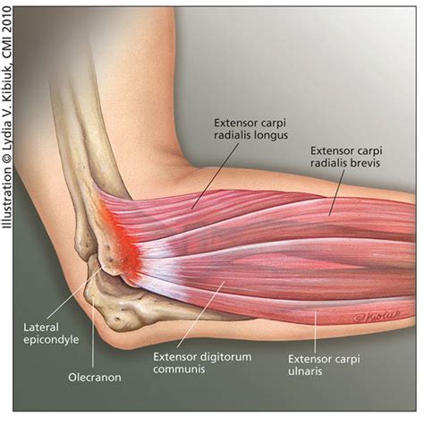 Traditional, Conservative Treatments for Tennis Elbow | HSS