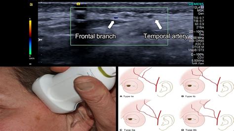 Temporal Artery Ultrasound