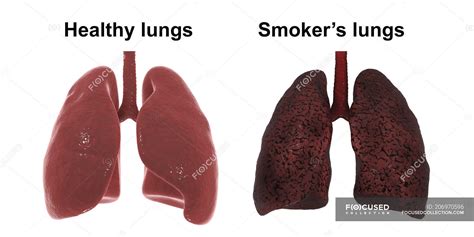 Comparison of healthy and smoker lungs, digital illustration ...