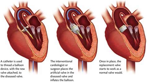 Heart Valve Replacement Surgery - Need, Types, Procedure, Benefits