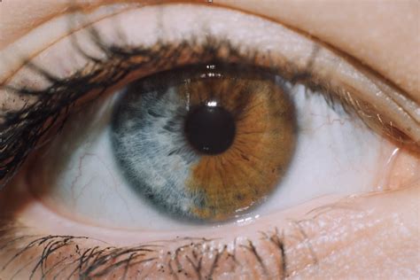 Heterochromia: A Beautiful Anomaly - Southeastern Ocularists Inc.