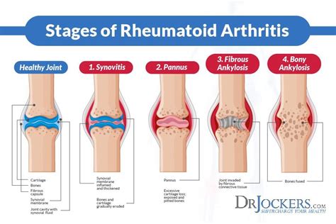 Arthritis: 7 most painful types of arthritis- cause, symptoms, treatments