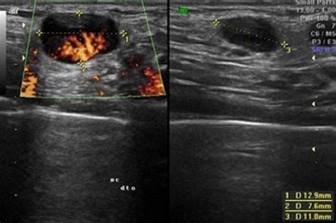 Supraclavicular Lymph Nodes Ultrasound - Ultrasound Of Superficial ...