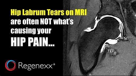 Acetabular Labrum Mri