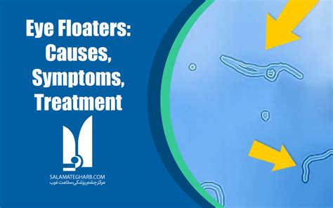 Eye Floaters: Causes, Symptoms, and Treatment - مرکز چشم پزشکی سلامت ...