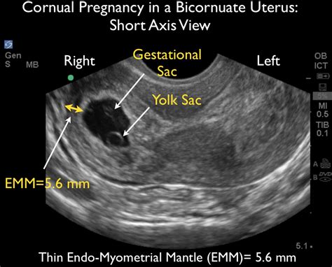 6 Week Transvaginal Ultrasound