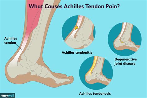 Achilles Tendon Pain: Symptoms, Causes, and Treatments