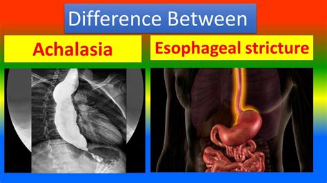 Difference Between Achalasia and Esophageal Stricture - YouTube