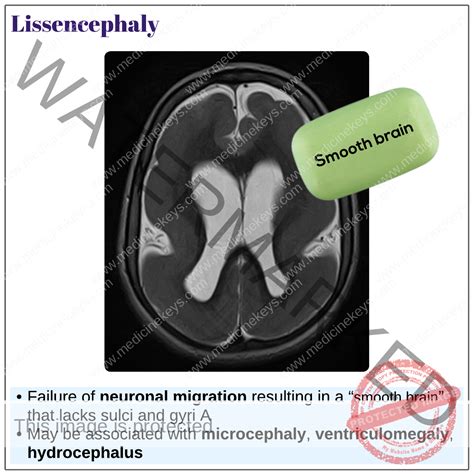 Lissencephaly - Medicine Keys for MRCPs