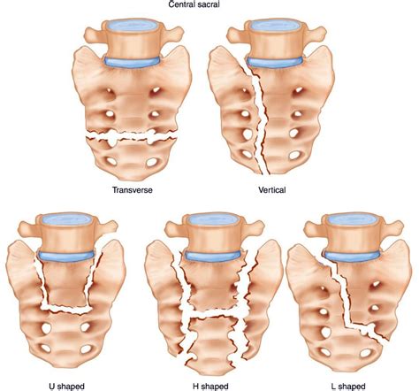 Sacral Fracture - El Paso, TX | Sciatica Pain and Treatment Clinic