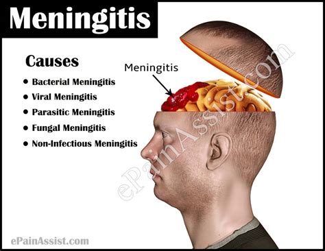 Meningitis: Treatment, Types, Causes, Transmission, Vaccine, Prevention