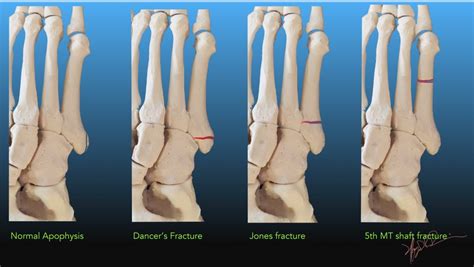 Fractures of the Fifth Metatarsal Base | UW Emergency Radiology