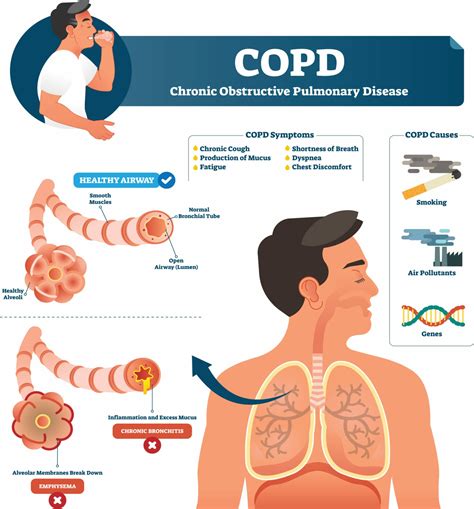 Chronic Obstructive Pulmonary Disease | COPD Treatment London