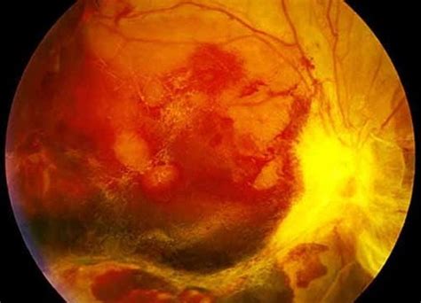 Diabetic retinopathy | Norway| PDF | PPT| Case Reports | Symptoms ...