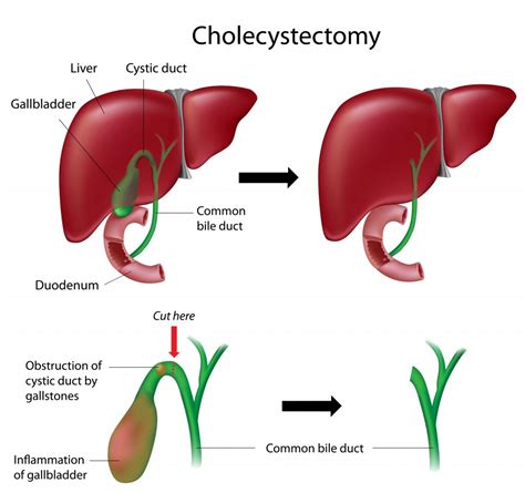 Cholecystectomy & SPL – GBMC Jordan