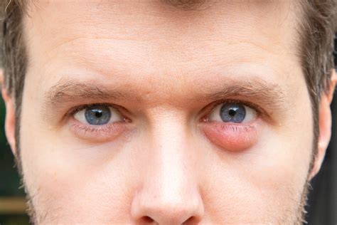 Stye vs. Chalazion | First Eye Care DFW | North Texas Optometrist