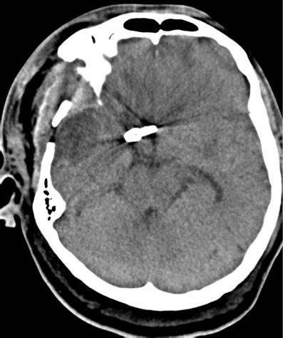 ACOM aneurysms – Radiology Cases