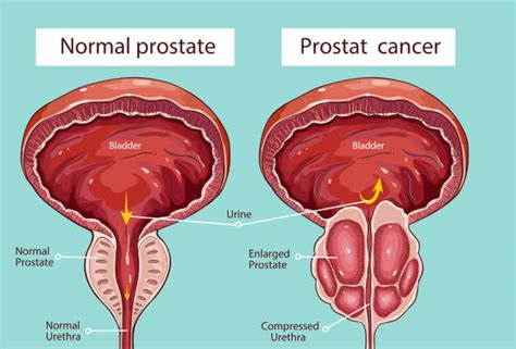 Prostate Gland Location Diagram