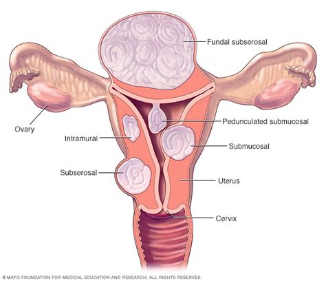 Fibromas uterinos - Síntomas y causas - Mayo Clinic