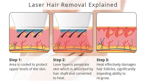 Laser Hair Removal And Epilepsy Top Sellers | centralcountiesservices.org