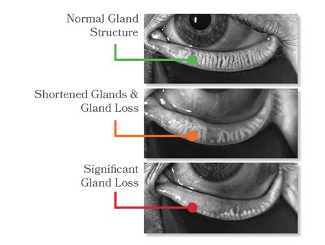 DRY EYE SYMPTOMS — Lifestyle Eye Center