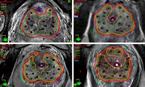 Cureus | Incorporating Routine Magnetic Resonance Imaging-based ...