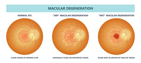 Symptoms of AMD: Am I at Risk? | Eye Specialist Institute | Gold Coast