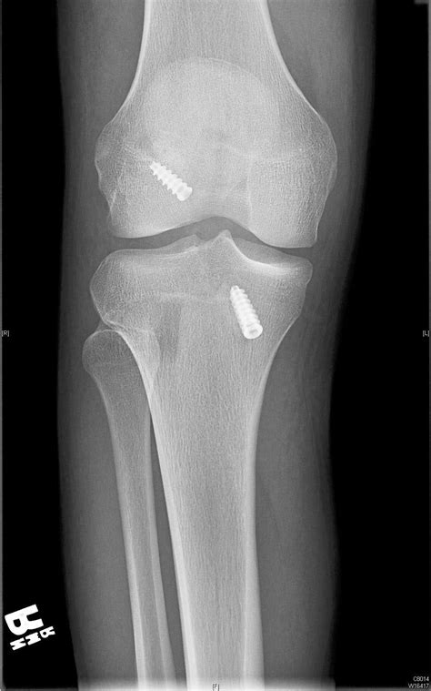 Acl Knee Injury | Minimalis