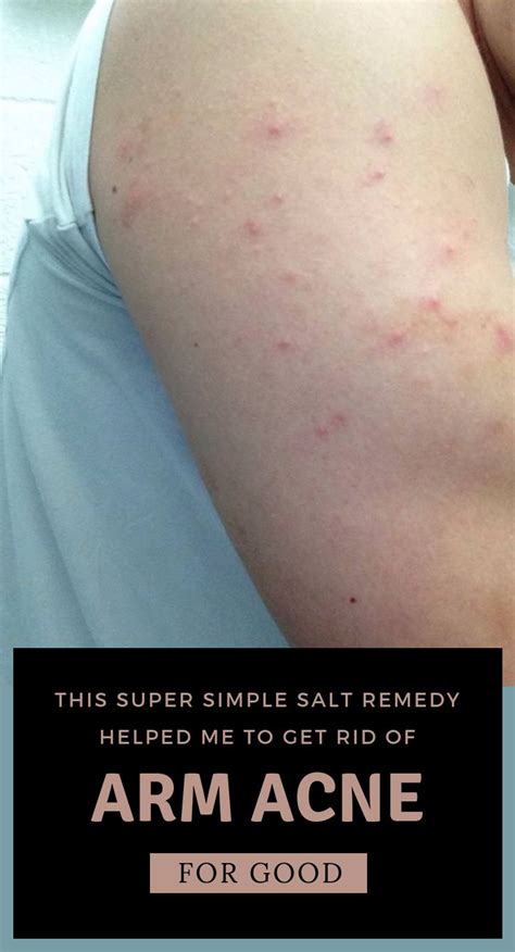 This Super Simple Salt Remedy Helped Me To Get Rid Of Arm Acne For Good ...