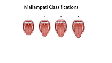 What Is The Mallampati Score and Why Knowing It Could Have A Huge ...