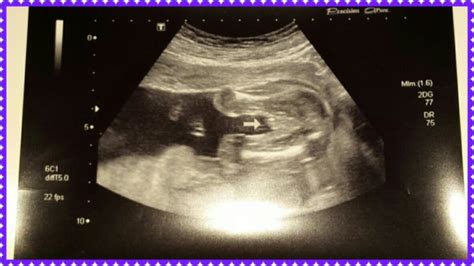 20 week ultrasound Help updated. It's a Boy | BabyCenter