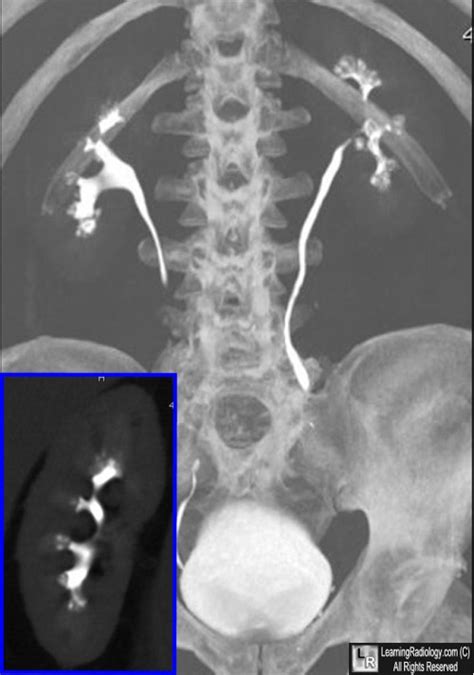 LearningRadiology - medullary, sponge, kidney