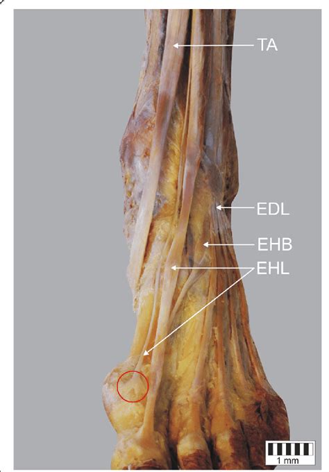 Extensor Hallucis Longus Tendon